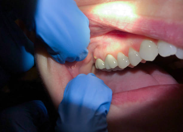Best Emergency Tooth Extraction in Pleasant Hills, MD